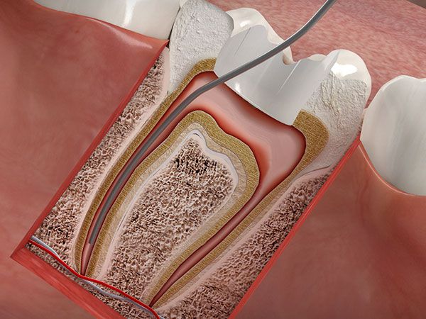 Wurzelbehandlung in Kaufbeuren für den Zahnerhalt